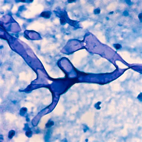 Mucormycosis Case Presentation Diagnosis And Management