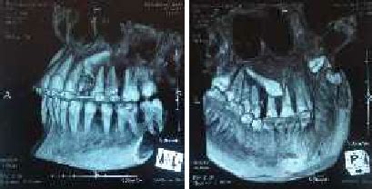 Cbct Evaluations Of Impacted Tooth Left Buccal View A Inferior