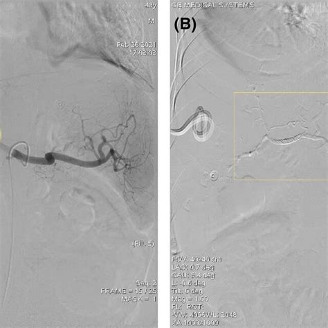 Urgent Digital Subtraction Angiography DSA A Pseudoaneurysm Of CHA