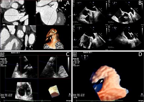 Accuracy And Reliability Of Left Atrial Appendage Morphology Assessment