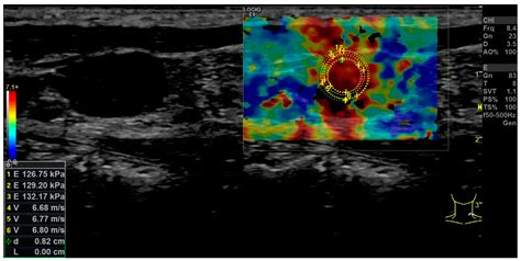 Diagnostics Free Full Text Multiparametric Ultrasound Of Cervical