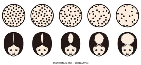 Female Pattern Hair Loss Set Stages Stock Vector (Royalty Free ...