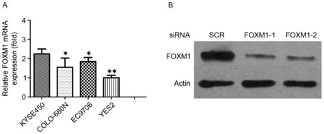 Overexpression Of Foxm1 As A Target For Malignant Progression Of