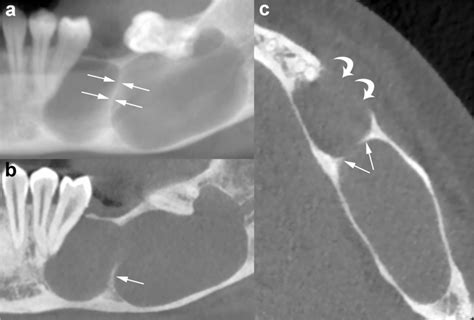 Odontogenic Keratocyst Imaging Features Of A Benign Lesion With An Aggressive Behaviour