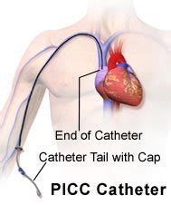 Caring for a Peripherally Inserted Central Catheter or Midline Catheter ...