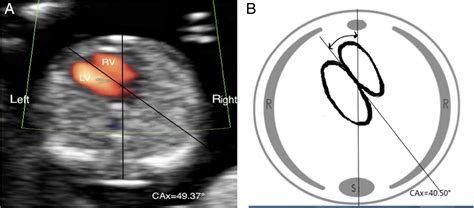 Contribution Of The Fetal Cardiac Axis And V‐sign Angle In First