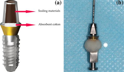 A Composition Diagram Implantanalog Body Lower Part And Abutment Download Scientific