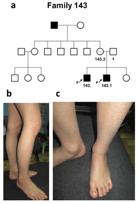 Ijms Free Full Text Genetic Heterogeneity Of X Linked Ichthyosis In