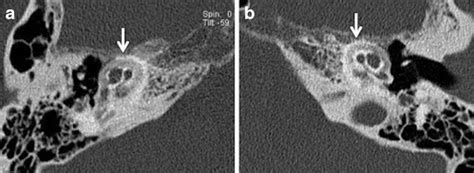 Imaging In Otosclerosis A Pictorial Review Insights Into Imaging Full Text