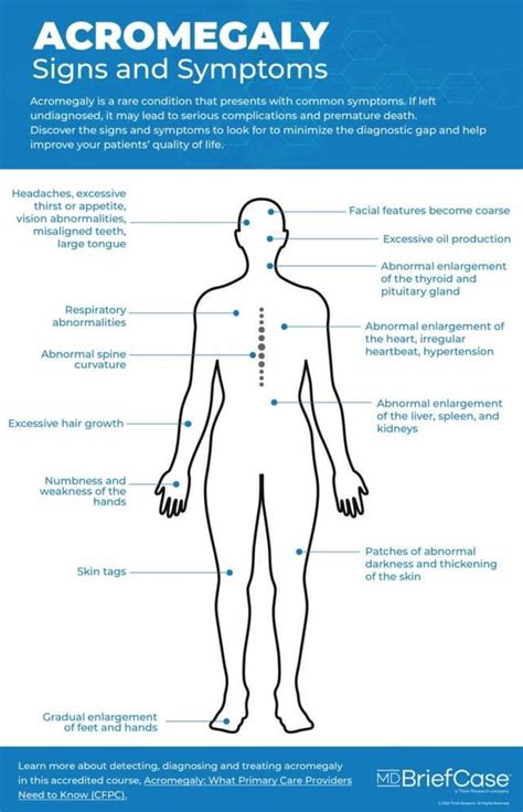 Acromegaly signs and symptoms : r/acromegaly