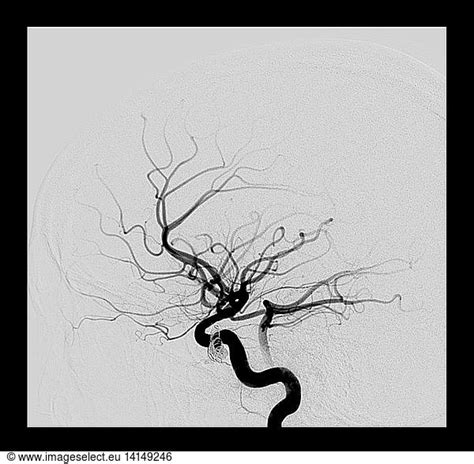 Traumatic Carotid Cavernous Sinus Fistula Traumatic Carotid Cavernous