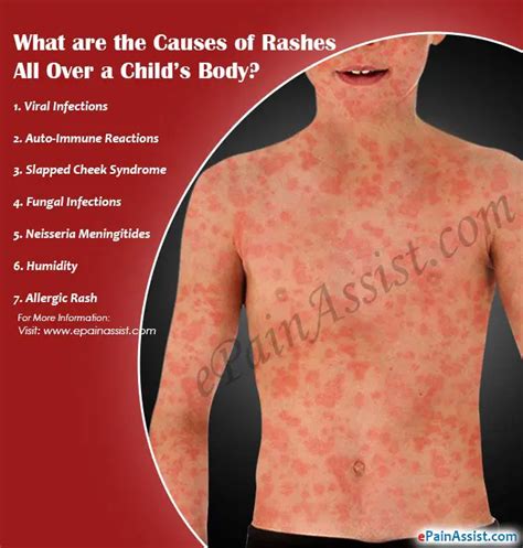 
Causes of Sudden Rash All Over Body