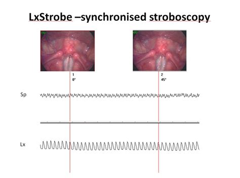 "Stroboscopy"