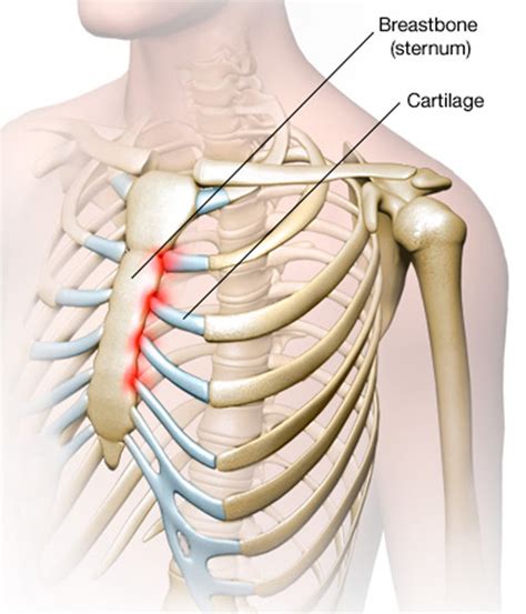 **1. Costochondritis**