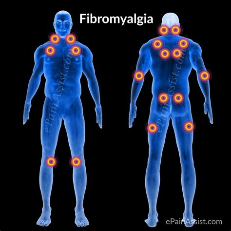 **Comprehensive Guide to Understanding and Managing Fibromyalgia Syndrome (FMS)**