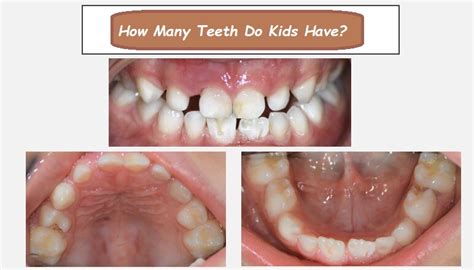 **How Many Teeth Does a Child Have: A Detailed Guide**