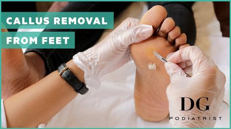 **Rid Your Feet of Calluses: A Guide to Callus Remover Oil**