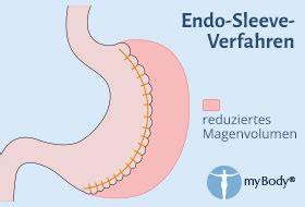 **Understanding the Sleeve (Magenverkleinerung): A Comprehensive Guide**