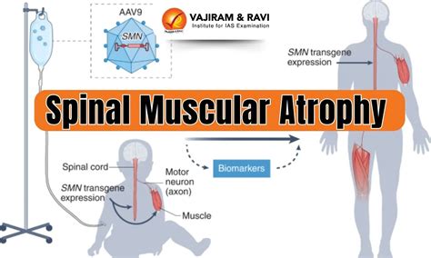 <h2>Common Mistakes to Avoid When Caring for Individuals with Spinal Muscular Atrophy</h2>