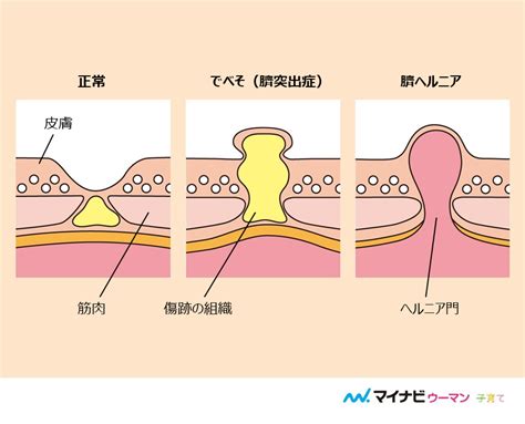 でべそ（臍ヘルニア）の遺伝について