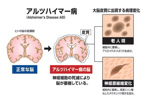 アルツハイマー病: