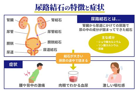 クランベリーが尿路結石予防と治療に役立つ科学的根拠