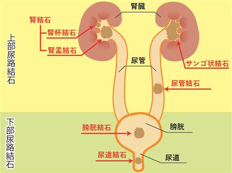 クランベリーと尿路結石