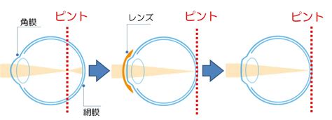 コンタクトレンズの利点