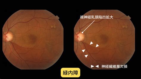 ダックスフントの目の病気：早期発見と治療が不可欠