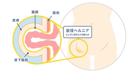 ヘルニアの治療法と予防に役立つヘルニアクロール