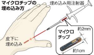 マイクロチップ埋め込みが日本でも普及拡大か