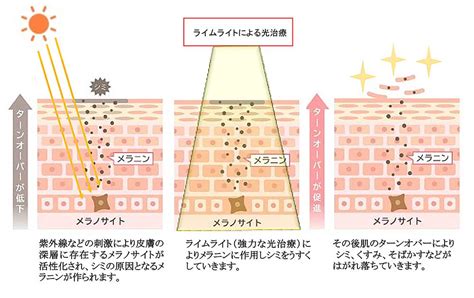 レーザー治療: