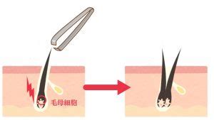 一つの毛穴から二本の毛が生える：その原因と対処法