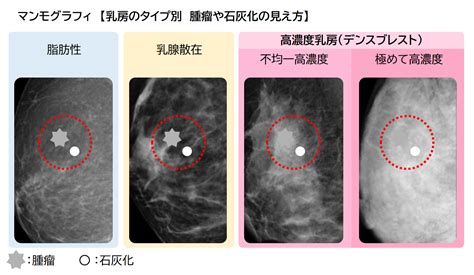 乳がんの総合ガイド