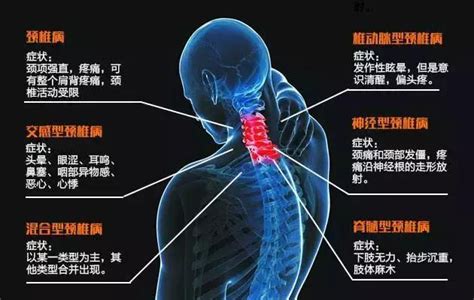 傳統應用：頸椎疾病的治療