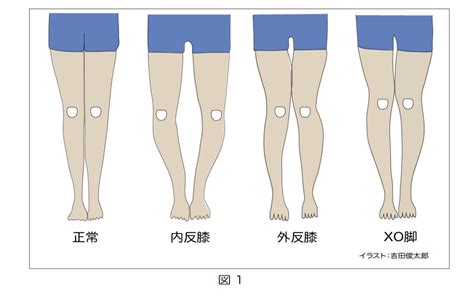 内反膝