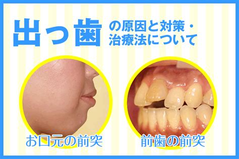 出っ歯の遺伝性: 原因、影響、治療法