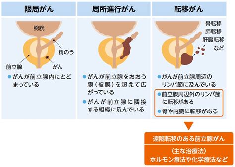 前立腺がんの男性のための包括的なガイド