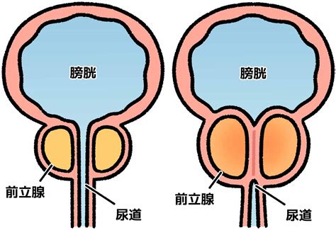 前立腺肥大症は必ず後ろ足の麻痺を引き起こしますか？