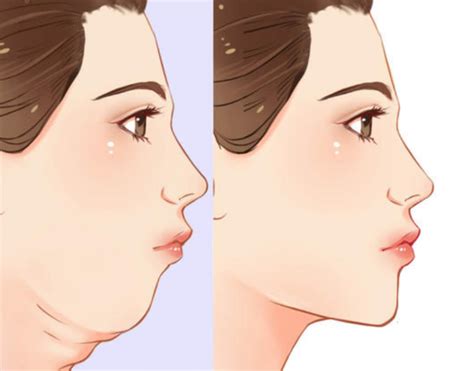 双下巴：成因、影响及有效改善策略
