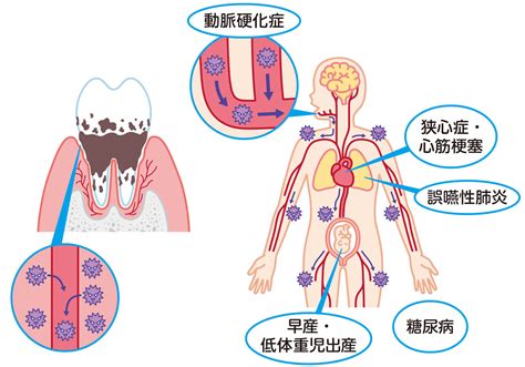 口腔内細菌の減少：