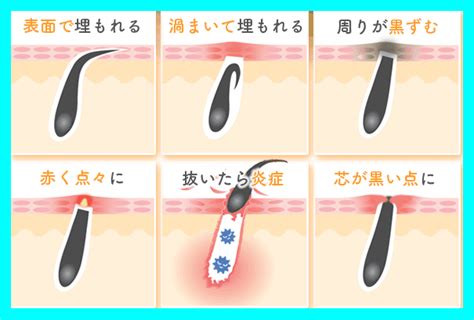 同じ毛穴から2本〜原因と対策〜