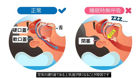 呼吸器系の問題（いびき、睡眠時無呼吸症候群）：