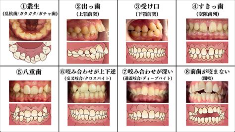 咬み合わせとは？