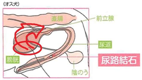 圧迫排尿