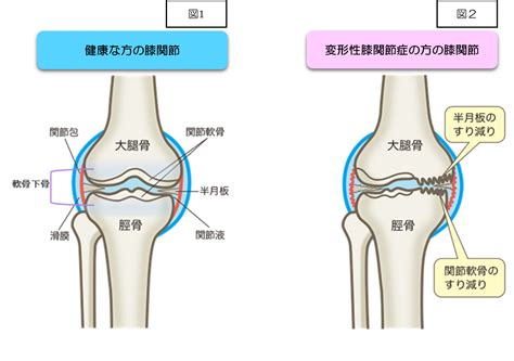 変形性膝関節症とは