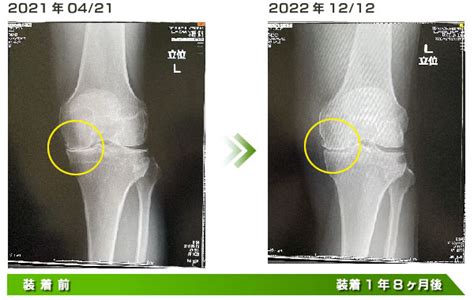 変形性骨関節症（OA）：