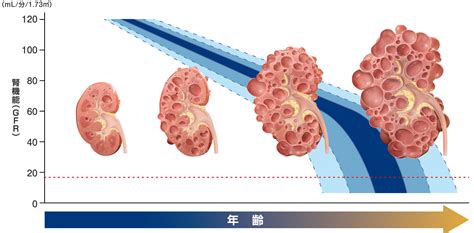 多発性嚢胞腎: