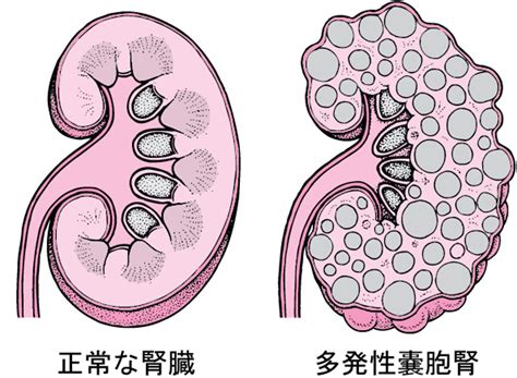 多発性嚢胞腎症（PKD）：