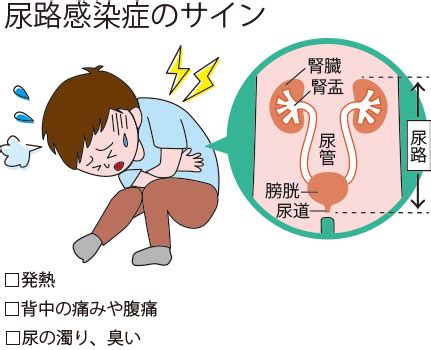 尿路感染症（UTI）の予防と治療